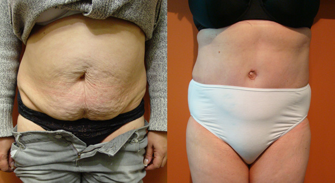 Tummy Tuck Patient 41 — Front View