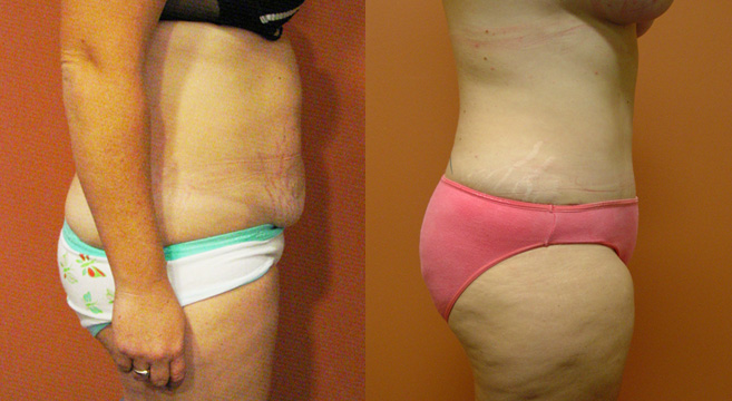 Tummy Tuck Patient 42 — Side View