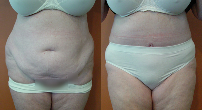 Tummy Tuck Patient 43 — Front View