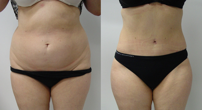 Tummy Tuck Patient 44 — Front View