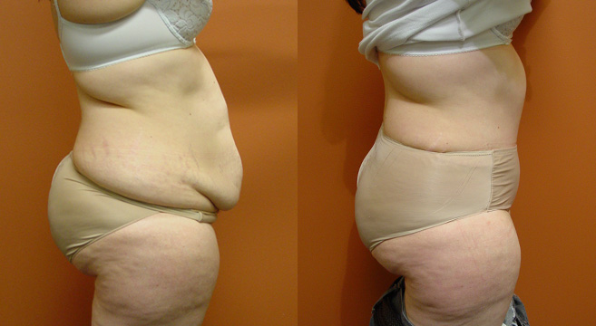 Tummy Tuck Patient 45 — Side View