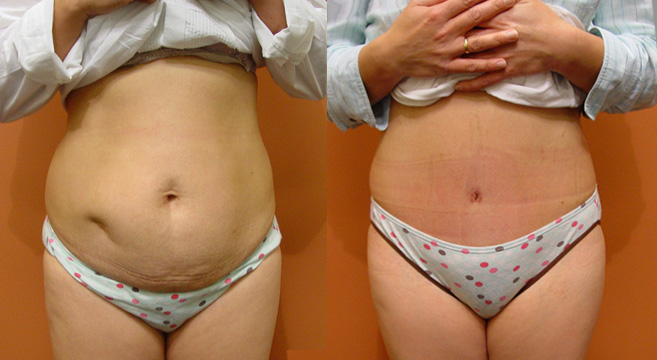 Tummy Tuck Patient 46 — Front View