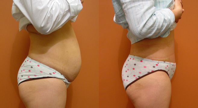 Tummy Tuck Patient 46 — Side View