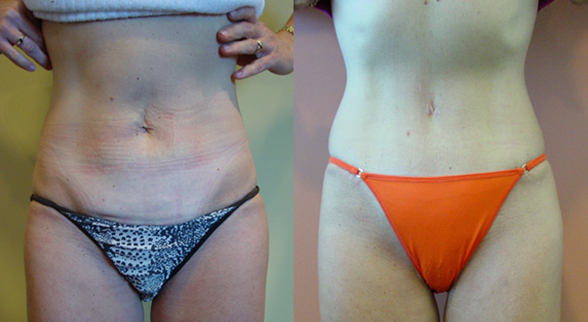Tummy Tuck Patient 47 — Front View