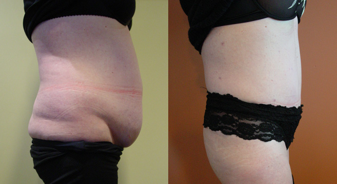 Tummy Tuck Patient 48 — Side View