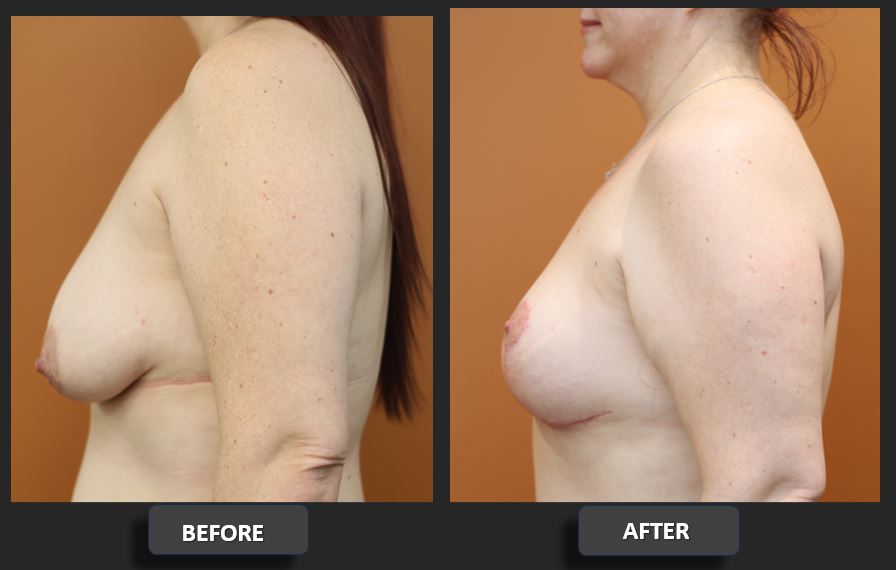 Breast reduction before and after – left side – Dr Harith Alani