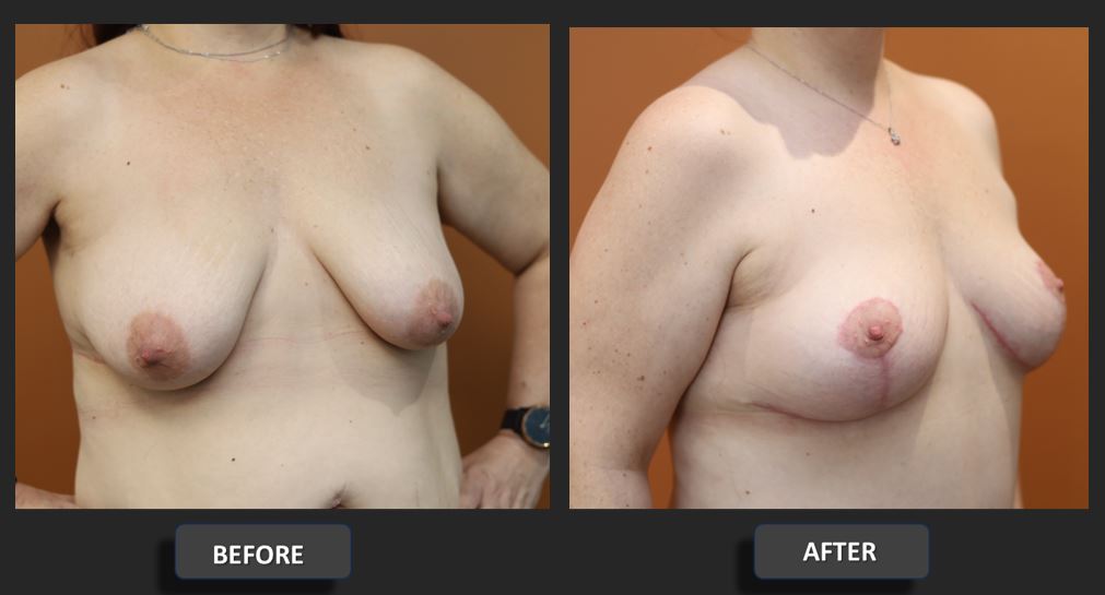 Breast reduction before and after – right oblique – Dr Harith Alani