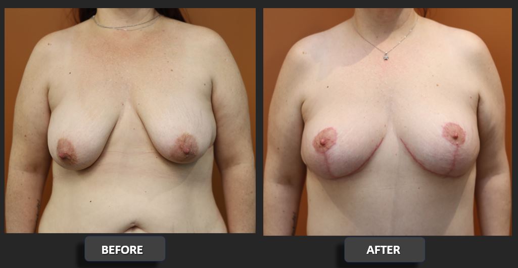 Breast reduction before and after – front – Dr Harith Alani