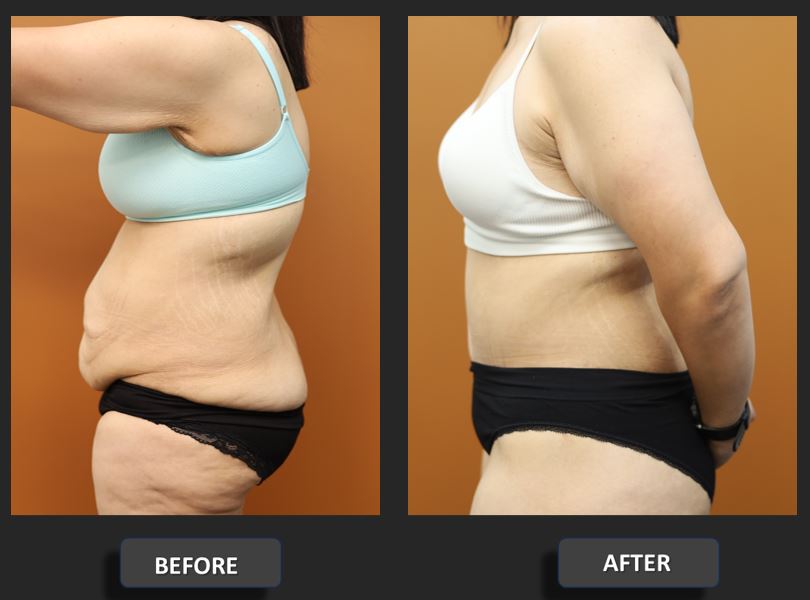 Abdominoplasty before and after – left side view – Dr Harith Alani
