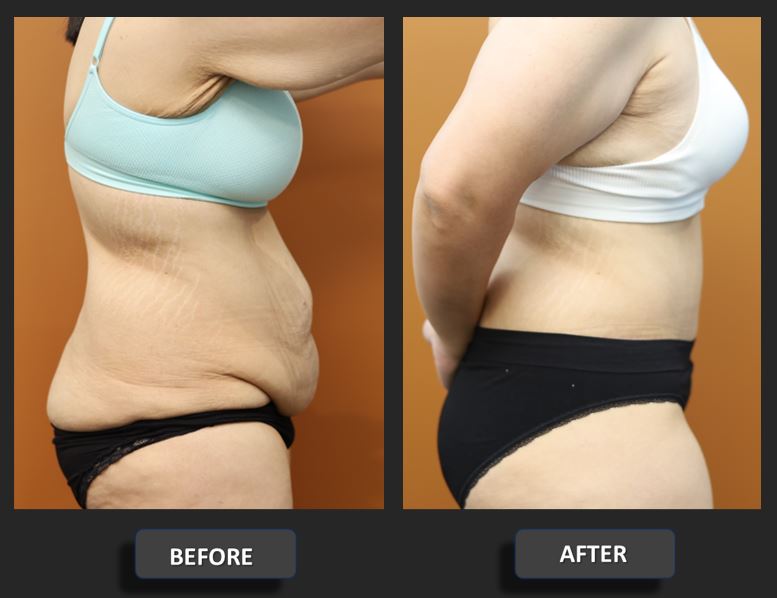 Abdominoplasty before and after – right side view – Dr Harith Alani