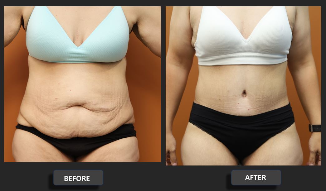 Abdominoplasty before and after – front view – Dr Harith Alani