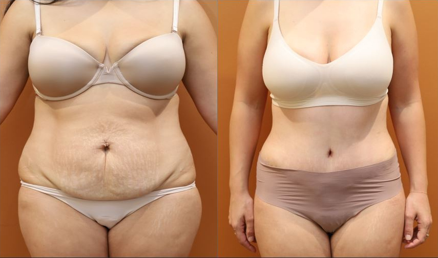 Abdominoplasty before and after – front view – Dr Harith Alani