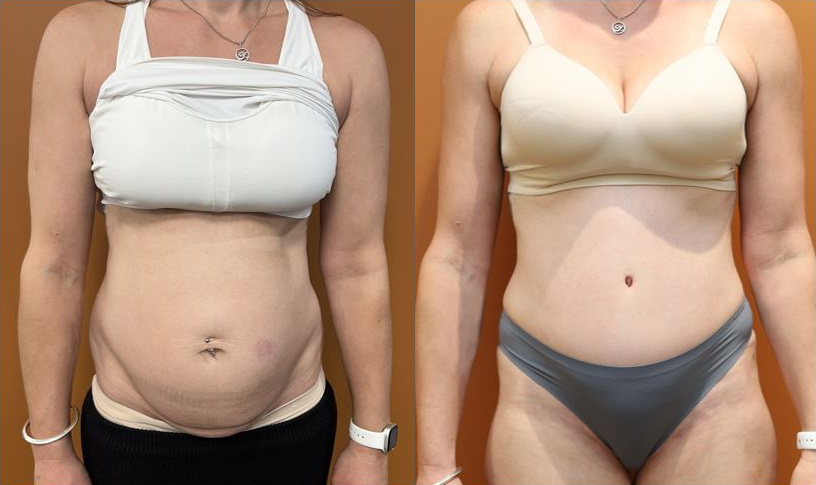 Abdominoplasty before and after – front view – Dr Harith Alani