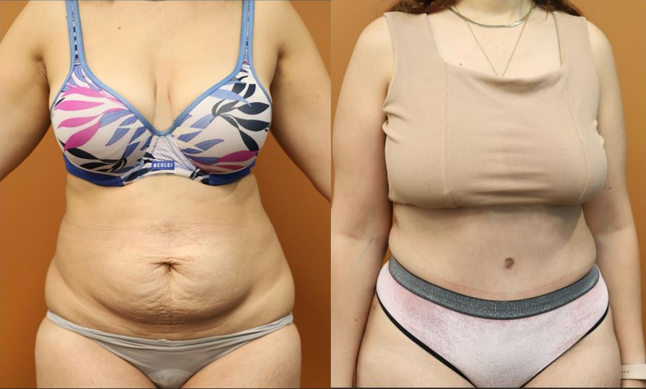 Abdominoplasty before and after – front view – Dr Harith Alani