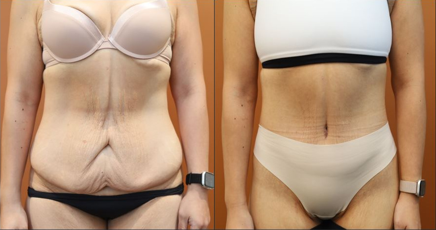 Abdominoplasty before and after – front view – Dr Harith Alani