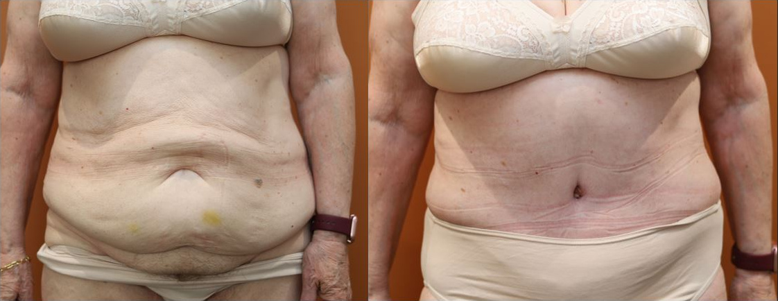 Abdominoplasty before and after – front view – Dr Harith Alani