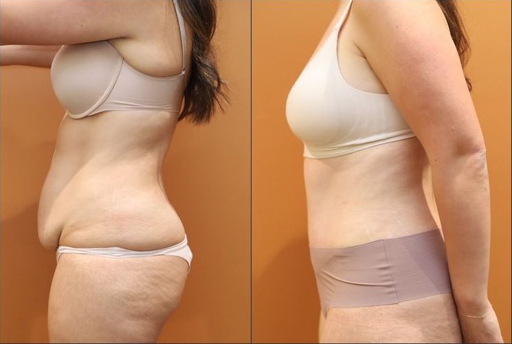 Abdominoplasty before and after – left side view – Dr Harith Alani