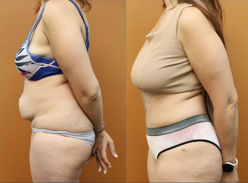 Abdominoplasty before and after – left side view – Dr Harith Alani