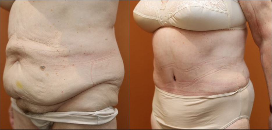 Abdominoplasty before and after – left side view – Dr Harith Alani