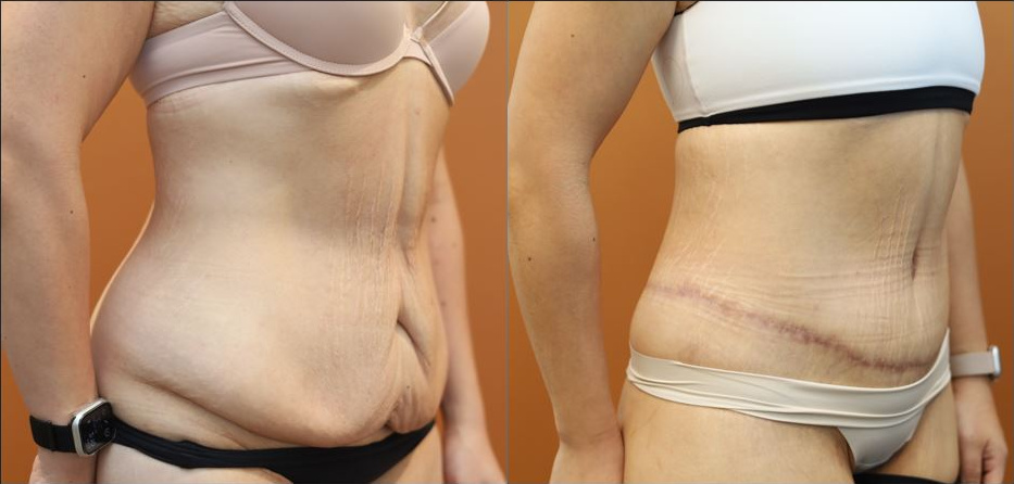 Abdominoplasty before and after – oblique view – Dr Harith Alani