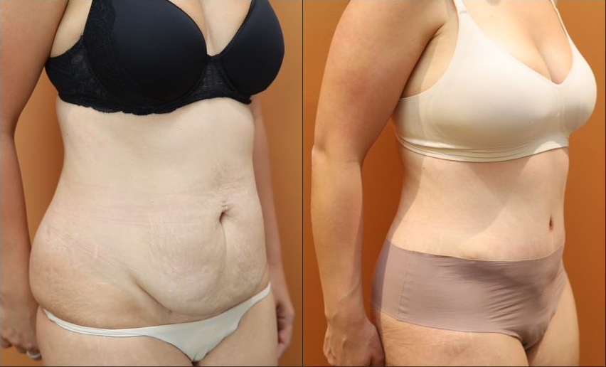 Abdominoplasty before and after – right side view – Dr Harith Alani