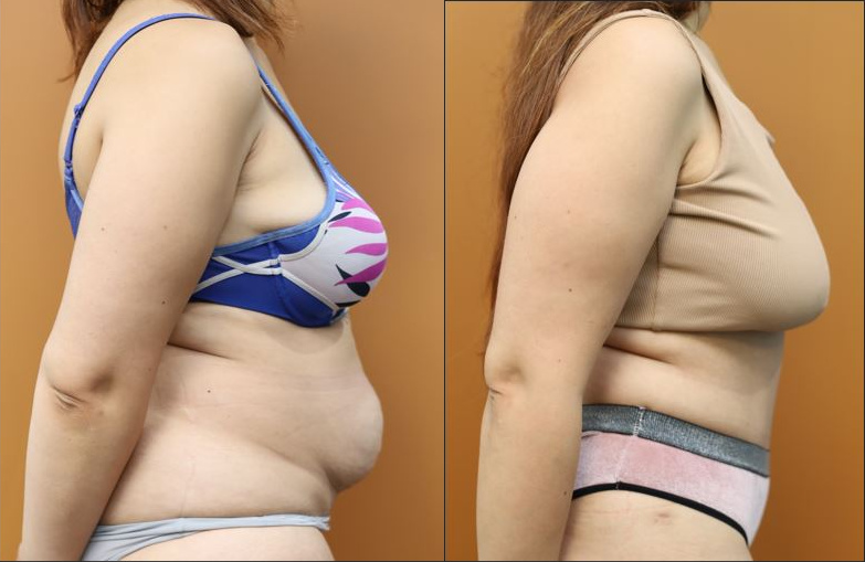 Abdominoplasty before and after – right side view – Dr Harith Alani