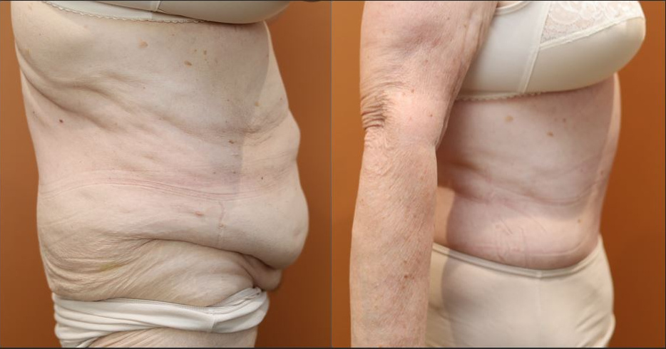 Abdominoplasty before and after – right side view – Dr Harith Alani
