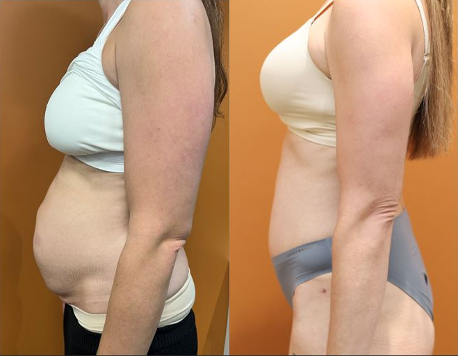 Abdominoplasty before and after – side view – Dr Harith Alani