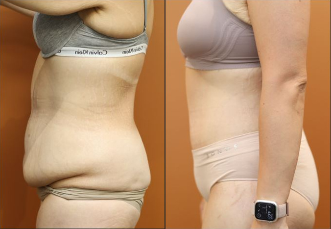 Abdominoplasty before and after – side view – Dr Harith Alani