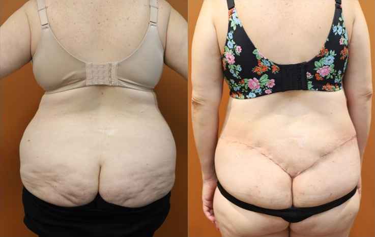 Lower body lift before and after – back view – Dr Harith Alani