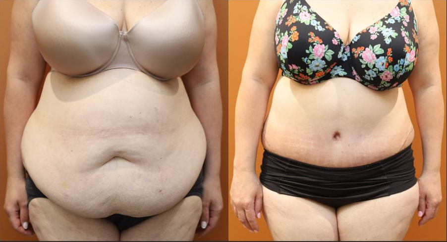 Lower body lift before and after – front view – Dr Harith Alani