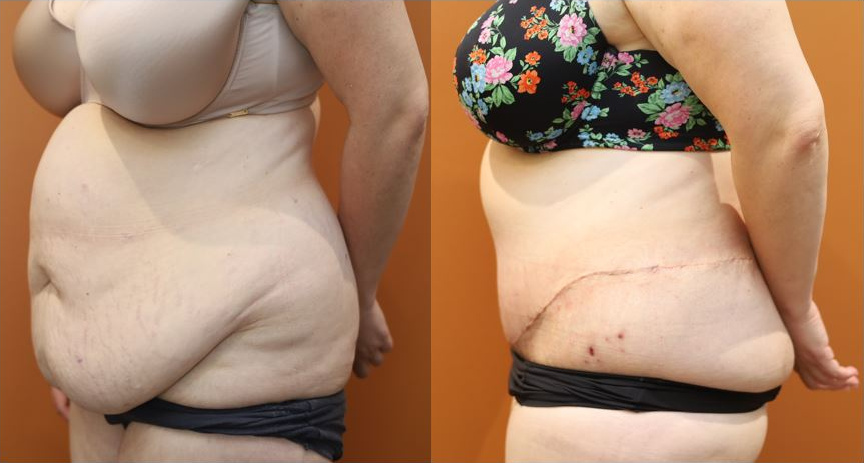 Lower body lift before and after – left view – Dr Harith Alani