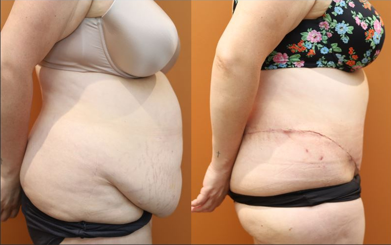 Lower body lift before and after – right view – Dr Harith Alani