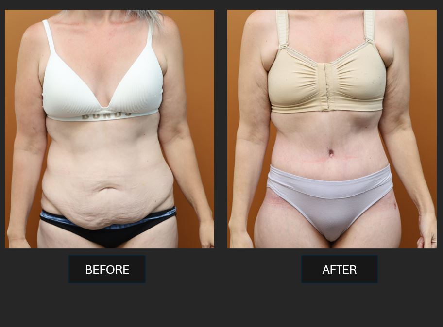 Abdominoplasty before and after - front view - Dr Harith Alani