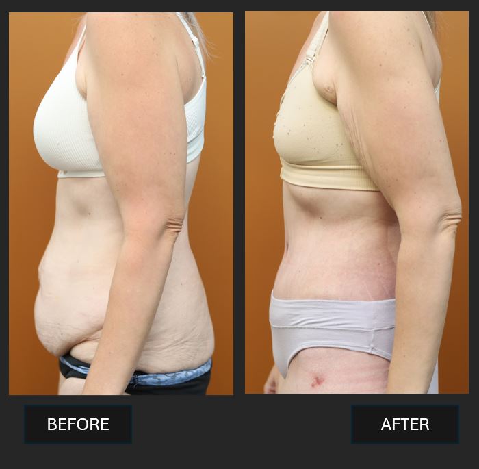 Abdominoplasty before and after - side view - Dr Harith Alani