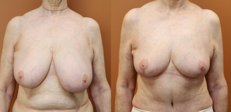 Breast reduction before and after – front view