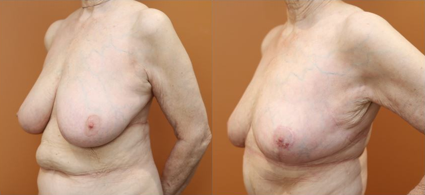 Breast reduction before and after – oblique view