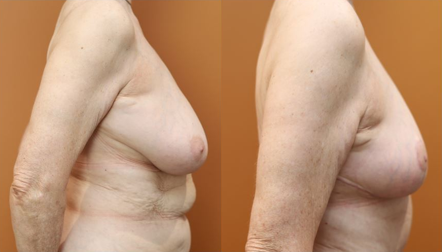Breast reduction before and after – side view