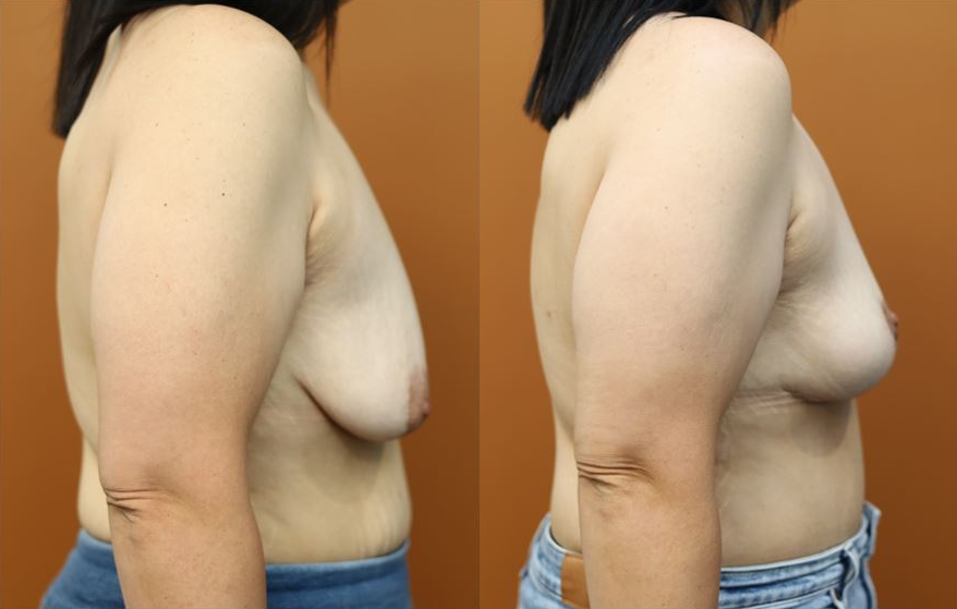 Breast reduction before and after – side view