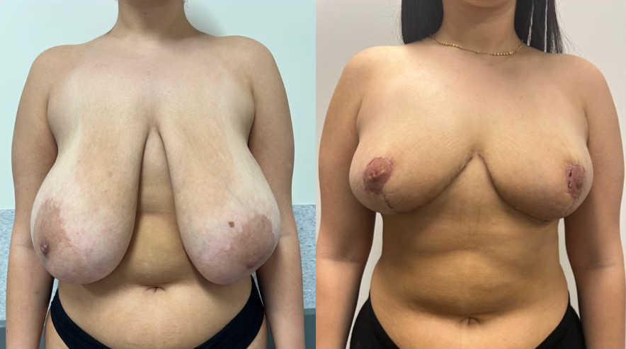 Breast reduction before and after – front view