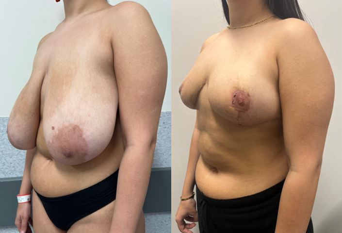 Breast reduction before and after – oblique view