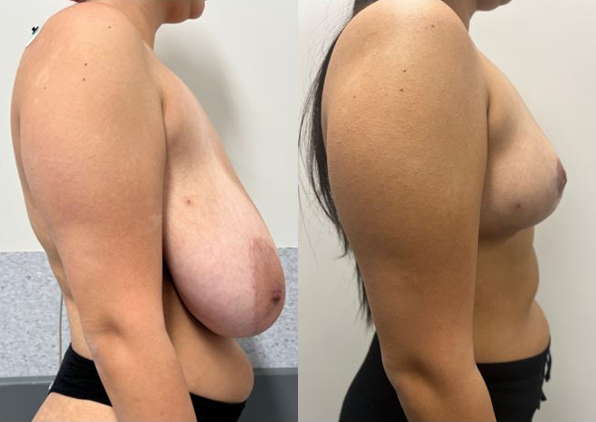 Breast reduction before and after – side view