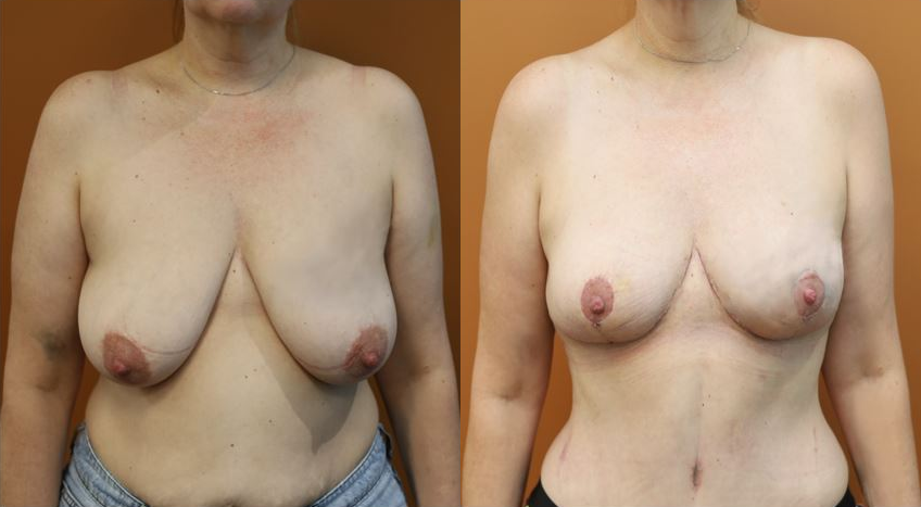 Breast reduction before and after – front view
