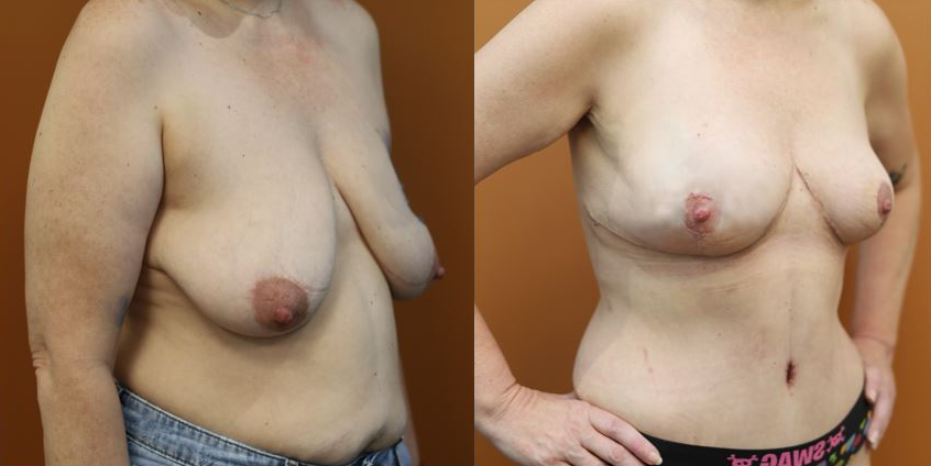 Breast reduction before and after – oblique view