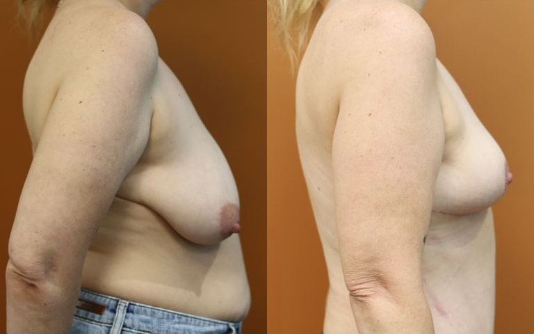 Breast reduction before and after – side view