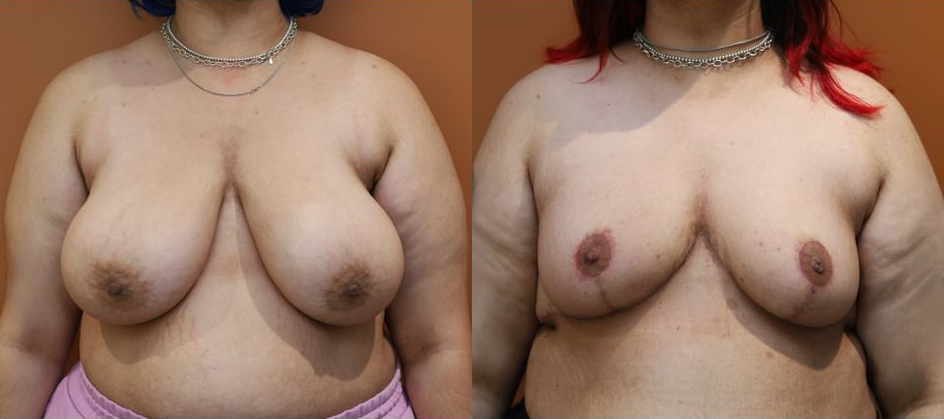 Breast reduction before and after – front view