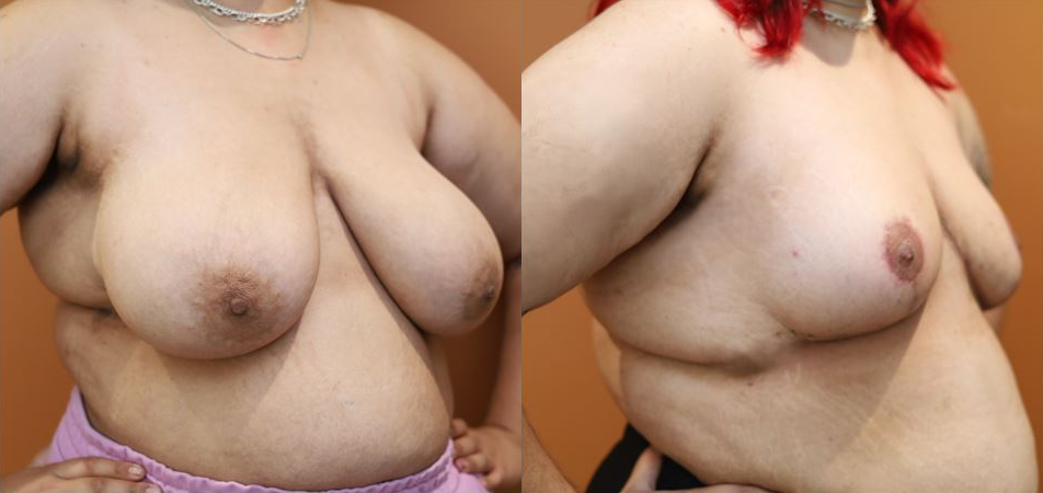 Breast reduction before and after – oblique view