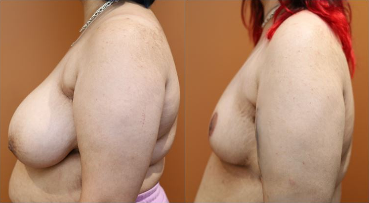 Breast reduction before and after – side view